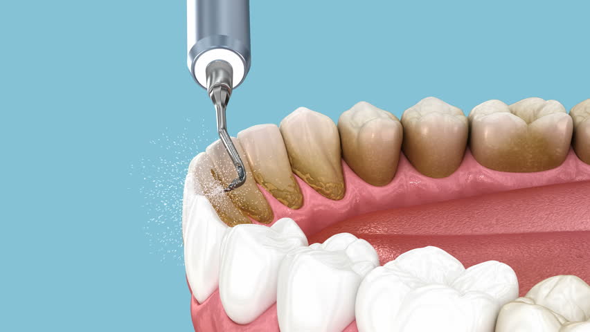 Teeth Cleaning Ultrasonic Scaling. Medically accurate 3D animation of human teeth treatment Royalty-Free Stock Footage #1105442263