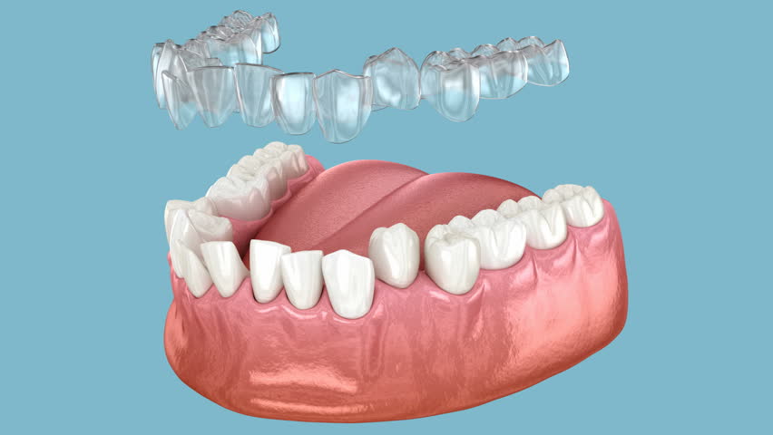 Invisalign braces or invisible retainer make bite correction. Medically accurate 3D animation Royalty-Free Stock Footage #1105442265