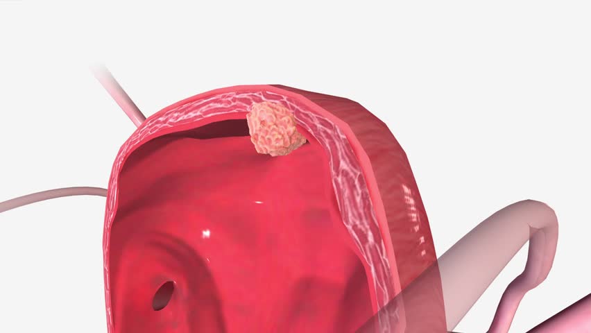 Bladder Cancer Stage II 3d medical Royalty-Free Stock Footage #1105638635