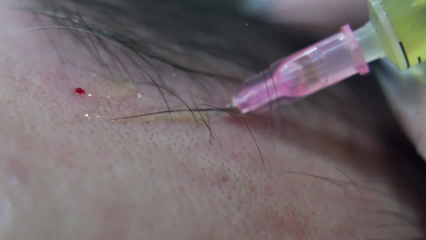 Macro shot of Hair mesotherapy procedure in the modern cosmetology clinic, plasma injectiions. Middle aged male patient prp procedure for hair regrowth Royalty-Free Stock Footage #1105793877
