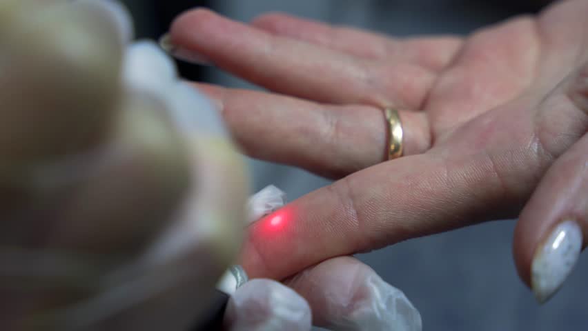 Doctor cosmetologist in gloves removees the birthmark with laser technology from the paatient finger in modern beaty clinic