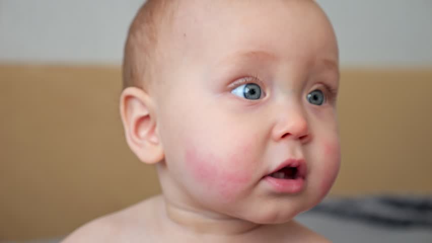 Baby girl with allergic reaction on cheekbones looks around with surprise. Small child with big blue eyes and red rash on cheeks portrait closeup