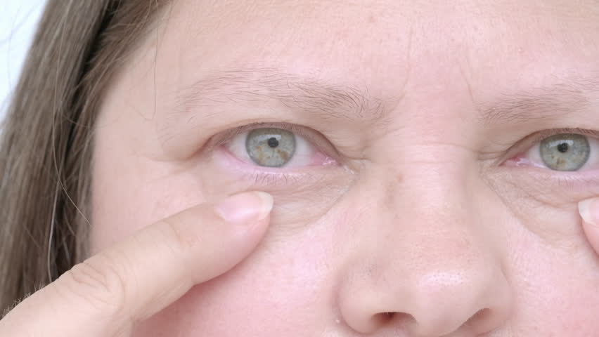 Mild swelling or puffiness under eyes, upper part of woman's face, an elderly woman close-up, small and large mimic wrinkles, concept poor vision, eye fatigue, correction of elasticity of aging skin | Shutterstock HD Video #1106037979