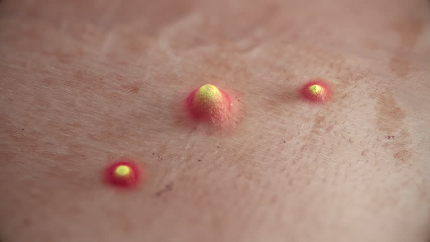 A Growing Pimples, Acne on the Skin. 3D Rendered Animation. Royalty-Free Stock Footage #1106086387