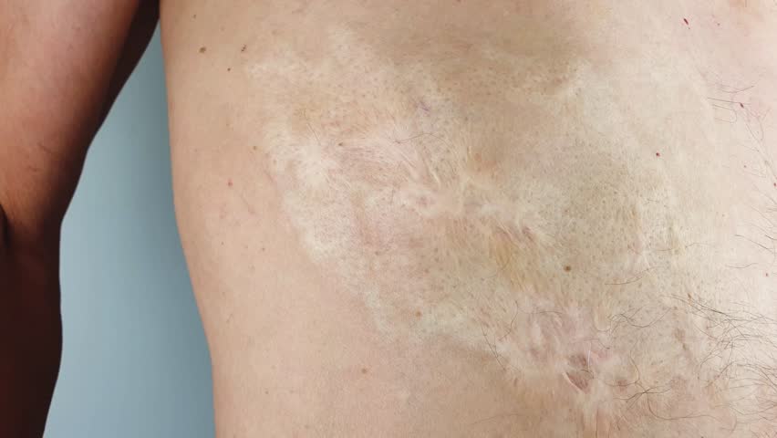 Burn scars, burn scars on the body. Consequences of burns.Burn marks on the man's body. Royalty-Free Stock Footage #1106093983