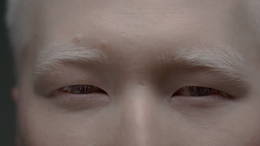 Close up portrait of the eye of an Asian albino guy. Genetic mutation of the pigment. Man with nystagmus, uncontrolled rhythmic movements of the eyeballs, Pathological nystagmus Royalty-Free Stock Footage #1106150979