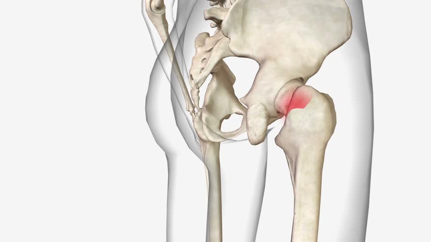 Femoral neck fractures are a specific type of intracapsular hip fracture . Royalty-Free Stock Footage #1106229927