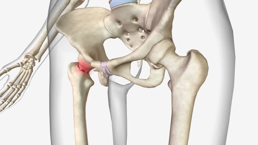 Femoral neck fractures are a specific type of intracapsular hip fracture . Royalty-Free Stock Footage #1106230053