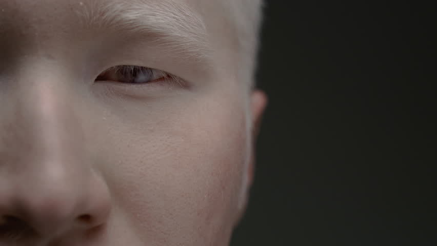 Close up portrait of the eye of an Asian albino guy. Genetic mutation of the pigment. Man with nystagmus, uncontrolled rhythmic movements of the eyeballs, Pathological nystagmus Royalty-Free Stock Footage #1106243629
