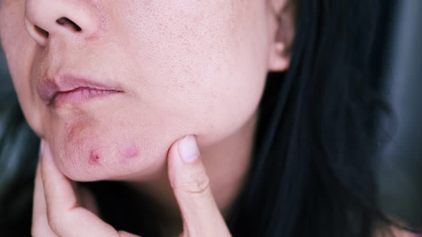Close up of sad woman touching acne on her face. Royalty-Free Stock Footage #1106289785