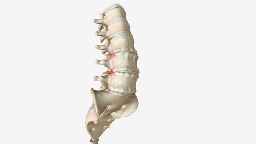 Degenerative disc disease isn't actually a disease, but rather a condition in which a damaged disc causes pain . Royalty-Free Stock Footage #1106310621