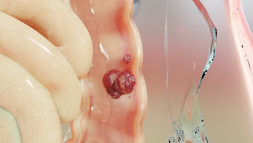 Bowel cancer or Colorectal tumor, Colon cancer,  intestine inflammatory bowel Disease,  intestine pain, celiac, infections, duplicating, cells expanding, malignant cancerous, viruses, 3d render | Shutterstock HD Video #1106356997