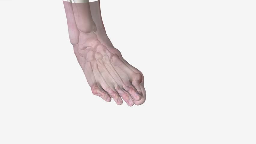 Bunions and Overlapping Toes 3d medical