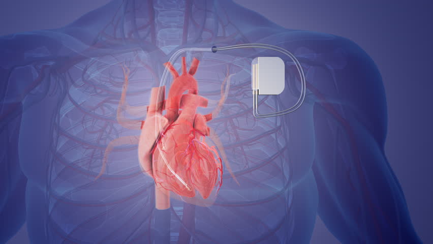 Permanent pacemaker implant medical concept  Royalty-Free Stock Footage #1106822021