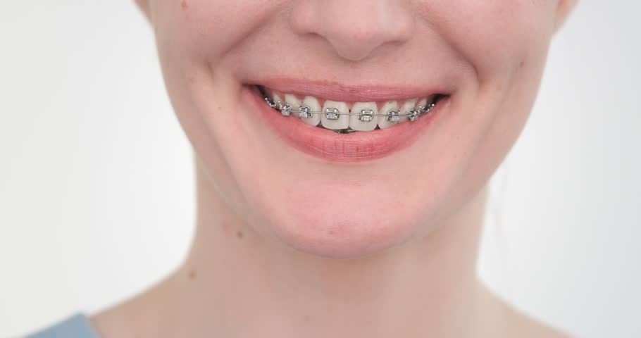Love of teeth braces system, white background. Adult woman like orthodontic treatment. Enjoy straight teeth. Happy beautiful teeth smiling in heart. Caucasian female braces smile. Cheerful person Royalty-Free Stock Footage #1106935799