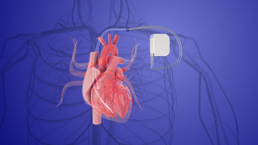 pacemaker in a human heart implant vein in the heart Royalty-Free Stock Footage #1106991211