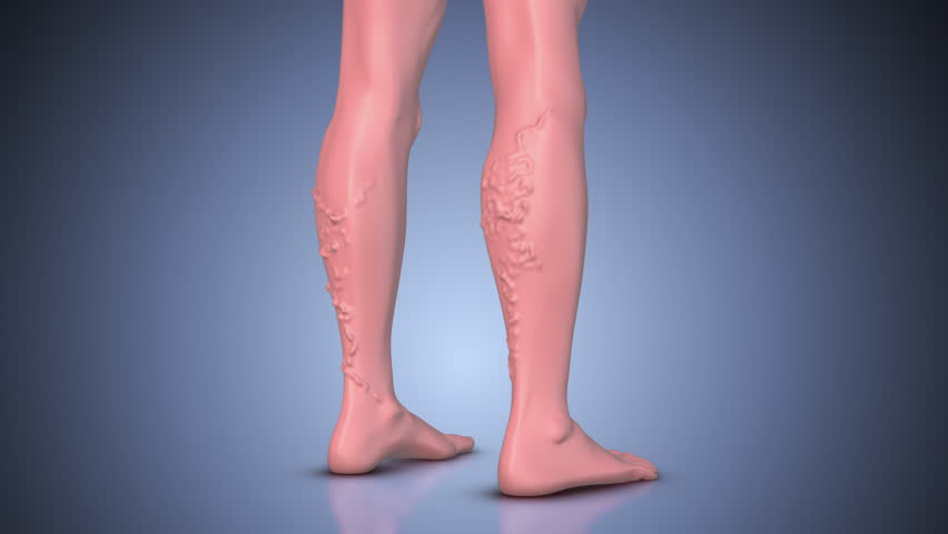 Concept of varicose veins, venous insufficiency, and vascular disease on leg Royalty-Free Stock Footage #1107113007