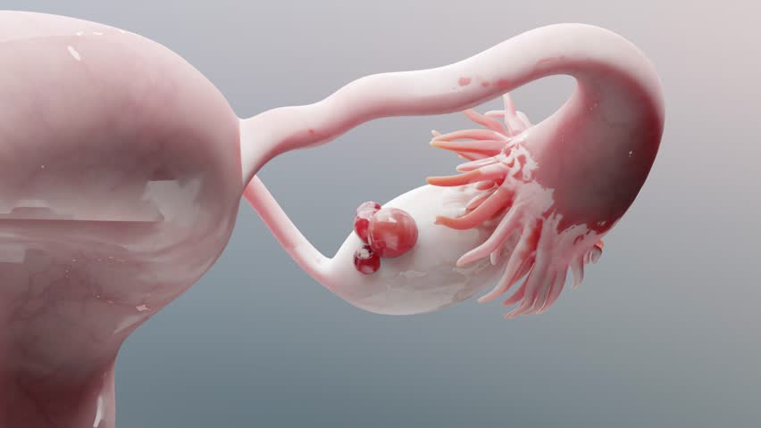 Ovarian malignant tumor, Female uterus anatomy, Reproductive system, cancer cells, ovaries cysts, cervical cancer, growing cells, gynecological disease, metastasis cancerous, duplicating, 3d render | Shutterstock HD Video #1107135505