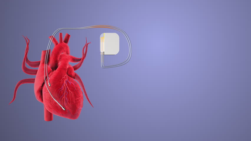 The heart and a cardiac pacemaker with heartbeat wave lines