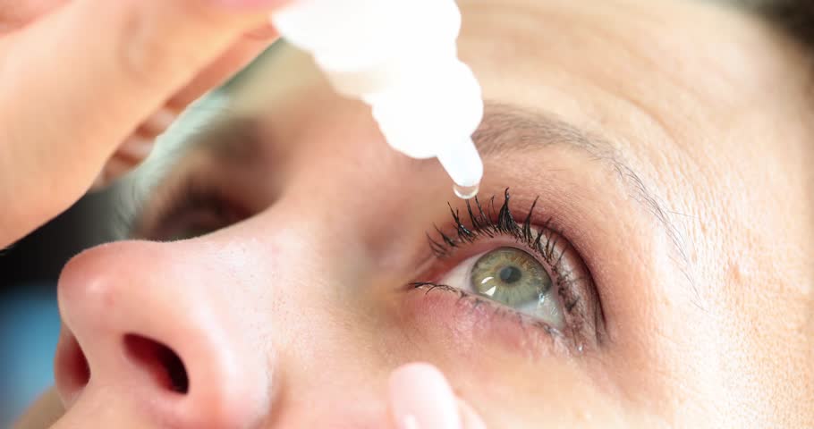 Closeup of woman pouring drops into red eye with conjunctivitis or glaucoma Royalty-Free Stock Footage #1107211165