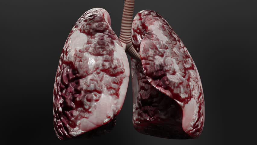 Pneumonia illness, healthy lungs and disease lungs, Human Lungs cancer, Cigarette smokers Lung disease, cancerous malignant tumor growing and spreading, respiratory system, asthma infection, 3d render | Shutterstock HD Video #1107581981