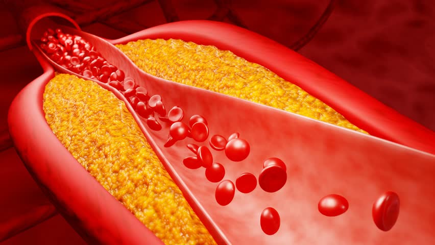 Artery clogged by unhealthy junk food, sugary drinks, and alcohol, illustrating serious cardiovascular risks, atherosclerosis, and heart disease problems in human blood vessels. 3D rendering.
