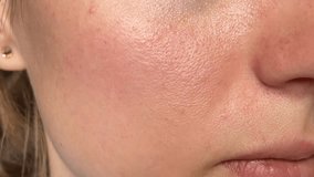 Macro video of big pore on oily facial skin type. Skin with enlarged pores. Care for problem skin. Oily and problem skin. Sun, natural light.