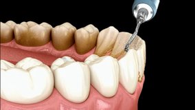 Periodontitis on the gums. Conceptual showing the dental cure of this disease. A healthy tooth is cut in half with the sick one. The video is in a loop.