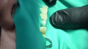 Dental Extreme Close up Macro Video. Dentist treat patient teeth. Orthodontist works with an assistant use cofferdam. Concept of professional dental hygiene. 4k 120 fps slow motion raw footage