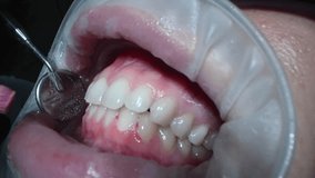 Woman at Dental chair in Dental Clinic. Dental Extreme Close up Macro Video. Cleaning process in patient's mouth. Concept of professional dental hygiene. 4k 120 fps slow motion raw footage