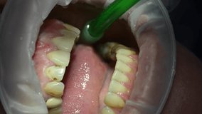 Dentist treat patient teeth. Orthodontist works with an assistant use cofferdam. Dental Extreme Close up Macro Video. Concept of professional dental hygiene. 4k 120 fps slow motion raw footage
