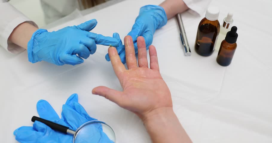Doctor smears hands with ointment to treat patients. Skin burn and treatment | Shutterstock HD Video #1108875981