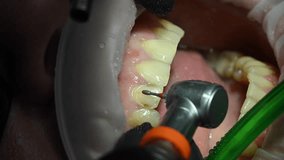 Dentist treat patient teeth. Orthodontist works with an assistant use cofferdam. Dental Extreme Close up Macro Video. Concept of professional dental hygiene. 4k 120 fps slow motion raw footage