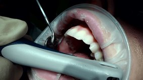 Dental Extreme Close up Macro Video. Dental Cleaning process in patient mouth. Clean teeth with water jet and saliva ejector. Concept of professional dental hygiene. 4k 120 fps slow motion raw footage