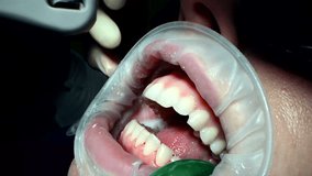 Dental Extreme Close up Macro Video. Dental Cleaning process in patient mouth. Clean teeth with water jet and saliva ejector. Concept of professional dental hygiene. 4k 120 fps slow motion raw footage