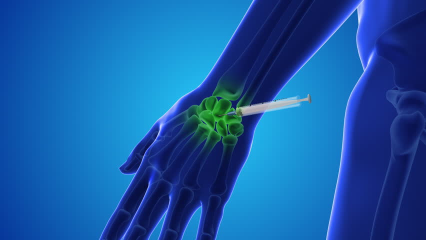 Injecting stem cells into a human wrist