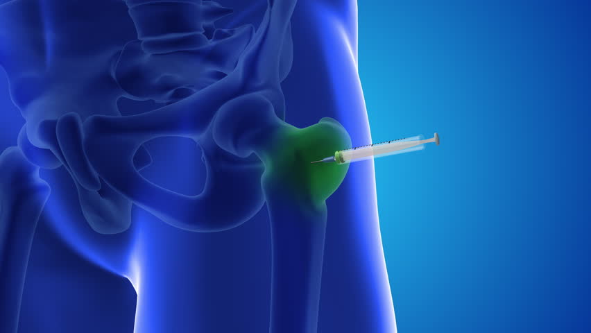 Injecting stem cells into a human thighs