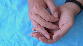 Close-up of Eczema Dermatitis on male hand and fingers. Skin peeling and desquamation of man hand on blue background. Strong allergic diathesis on hands. Red, cracked skin with blisters. Medical video