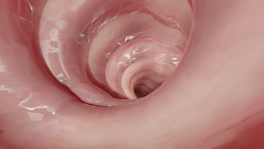 Colorectal cancer, malignant tumor in intestine, Endoscope inside colonoscopy, gut intestine, Colon polyp removal, colonic polyps search, Polypectomy, intestinal carcinoma, bowel neoplasia, 3d render  | Shutterstock HD Video #1109508567