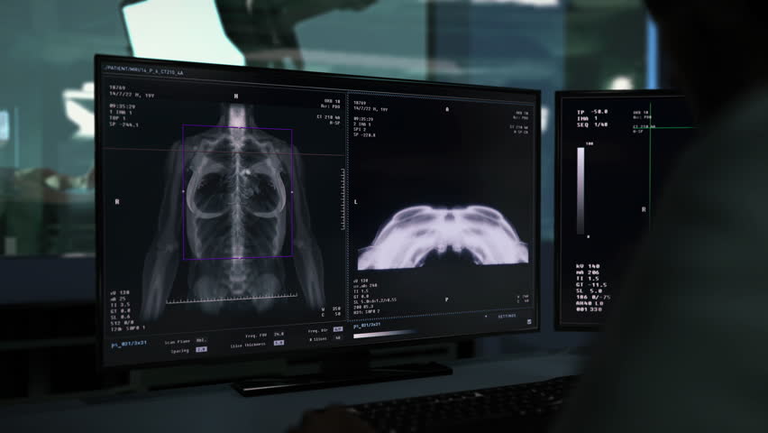 Using Medical Analysis Test System For Breast Cancer Diagnostic. Medica Diagnostic Test. Mammography Screening. Medical Test Technology. Examination At Hospital. Hospital Scanner. Radiology Royalty-Free Stock Footage #1109646489