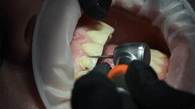 Dental Extreme Close up Macro Video. Dentist treat patient teeth. Dental internist works with an assistant use cofferdam. Concept of professional dental hygiene. 4k 120 fps slow motion raw footage