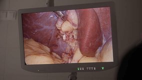 Close up of monitor hanging on wall in modern operating room. Professional surgeons use endoscope in difficult surgery. Medics look at video from endoscope to operate patient. Medical staff at work.