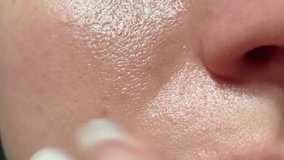 Macro video of big pore on oily facial skin type. Unhealthy oily facial skin with enlarged pores and shiny sebum, texture part of the face.