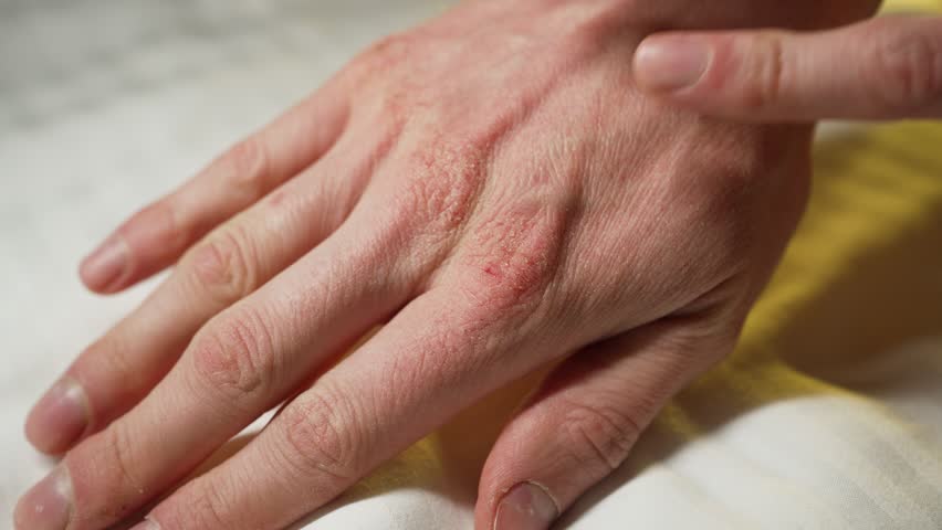 A man examines his dry, cracked skin on his hand in close-up. Dry skin in winter from frosty weather and dry air due to heating. Royalty-Free Stock Footage #1110367519