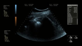 CGI video of modern ultrasonography scan image and program interface design for medical equipment display