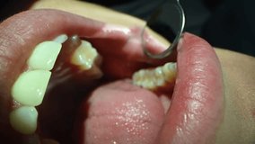 Dental Care Extreme Close up Macro Video. Dentist treat patient teeth. Orthodontist works with microscope and dental mirror. Concept of professional dental hygiene. 4k 120 fps slow motion raw footage