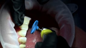 Dentist polishing patient teeth. Dental internist works with an assistant use cofferdam. Dental Extreme Close up Macro Video. Concept of professional dental hygiene. 4k 120 fps slow motion raw footage