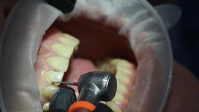 Dental Extreme Close up Macro Video. Dentist treat patient teeth. Dental internist works with an assistant use cofferdam. Concept of professional dental hygiene. 4k 120 fps slow motion raw footage