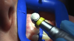 Dental Whitening process in patient mouth. Teeth whitening with UF Lamp, Led Lamp and gel. Dental Extreme Close up Macro Video. Concept of professional dental hygiene. 4k 120 fps slow motion footage