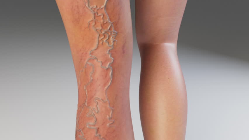 Varicose Veins treatment